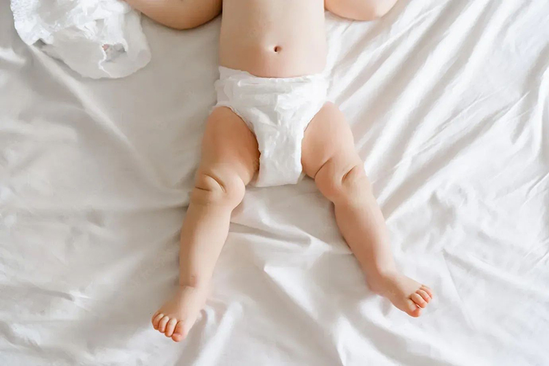 Penyebab dan Tips Mencegah Ruam Popok Bayi